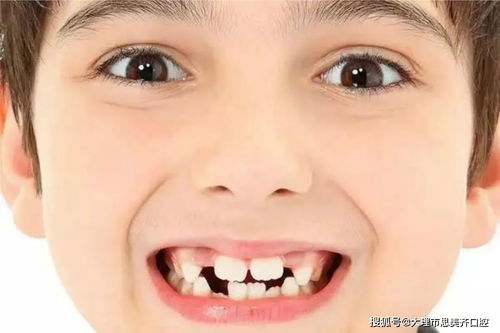 换完牙后,孩子的门牙竟成了 大板牙