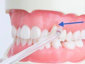 日本牙医都在推荐,在家就能体验 洗牙