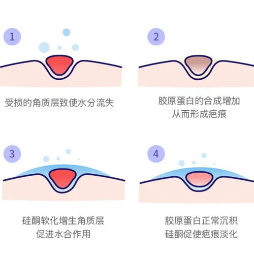 疤痕贴真的可以淡化疤痕吗 看完秒懂 平创