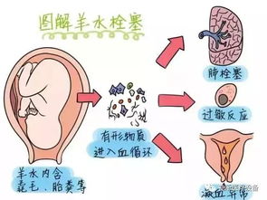 刘强东妹妹42岁生三胎去世,夺走她的是产科死亡率排第一的疾病