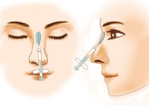 玻尿酸（透明质酸）注射脸部填充效维持多长？
