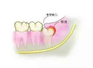 智齿弄不好还会毁容 你的智齿还好吗