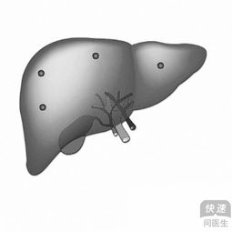 肝硬化支持切除脾吗