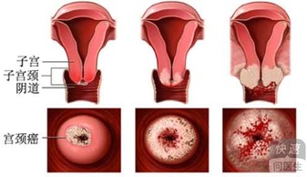 子宫癌可能催生卵巢肿瘤 3种子宫癌食疗方