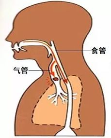 坠床 呛入异物,540个孩子意外致死,急救必须学 