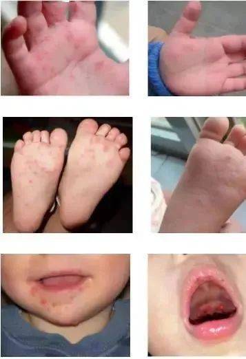 手足口病的疱疹几天能消下去，手足口病疱疹几天消退