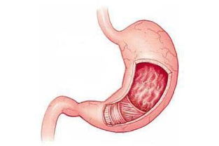慢性胃炎的治疗方法，慢性胃炎的治疗方法