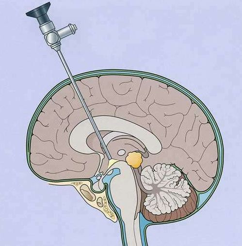 脑积水,只能做脑室腹腔分流吗