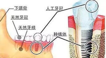 种植牙技术发展简史