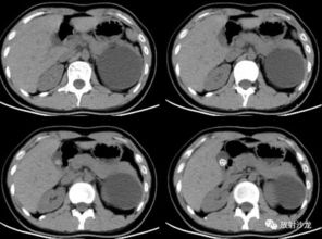 病例解析 胰腺粘液性囊腺瘤 