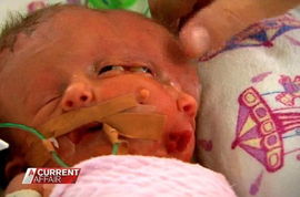 澳洲女子产下双面女婴 取名为信仰和希望 