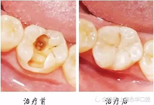 小洞不补,大洞吃苦 补牙到底疼不疼呢 