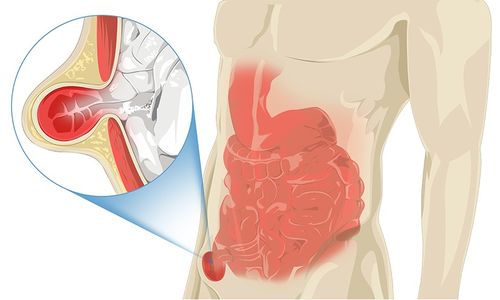 吓死 80岁爷爷大腿间长了个包,竟是 肠子 跑了出来