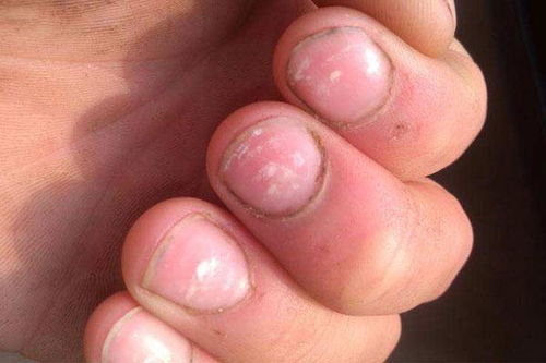 指甲黑线癌症前兆图片 指甲有黑线是怎么回事？ 
