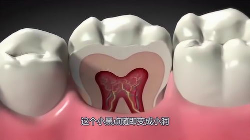 蛀牙是怎么形成的呢 3D动画模拟全过程, 蛀虫 长这样 