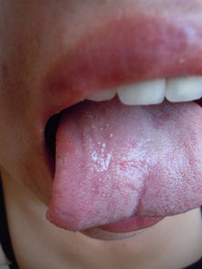 舌头上长了白点点 