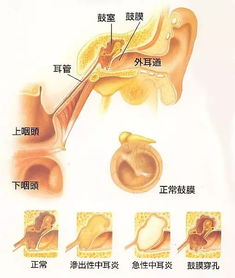 怀化惠耳 中耳炎六大误区,久病不治损听力