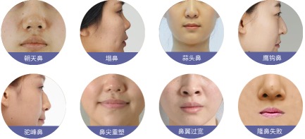 鼻部整形怎么样、鼻部整形的优缺点是什么？