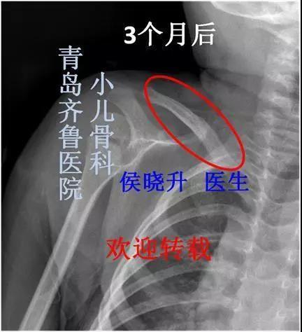 儿童锁骨骨折99 不需要手术治疗,专家告诉你原因在这里