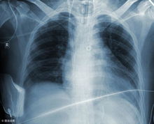 肺部有阴影就一定是肺癌吗 三类人要特别当心肺部阴影