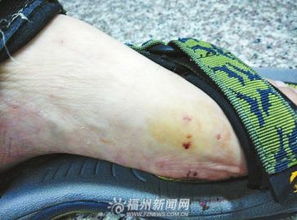 男生脚受伤流血的照片 