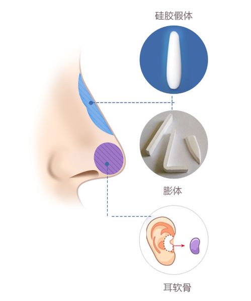 什么是线雕隆鼻