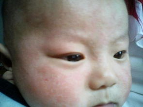 三个月大的宝宝脸上长湿疹怎么办