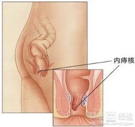 内痔要手术吗(内痔可怕还是外痔可怕)