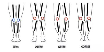 怎么让腿变直，膝盖有点向内靠拢(怎么让腿变直的动作)