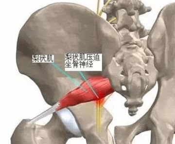 腰疼腿麻可不一定是腰脱,也许是这块肌肉出问题