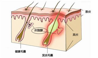 痘痘闭合总是反反复复,你的水乳,防晒都有问题哦 