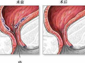 痔疮出血了是怎么回事呢(痔疮出血咋办?)