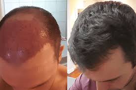 移植头发怎么弄好看，头发移植后如何护理受伤皮肤(移植头发后要注意什么)