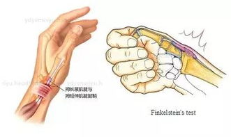 2个手指肌腱缝合25天握不紧拳头