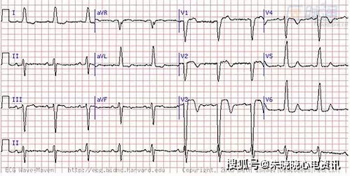 T波改变(II,III,avF低平或倒置)是什么意思-图2