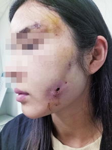 女子郑州做脂肪填充脸上溃烂流脓 找美容院维权被拉黑