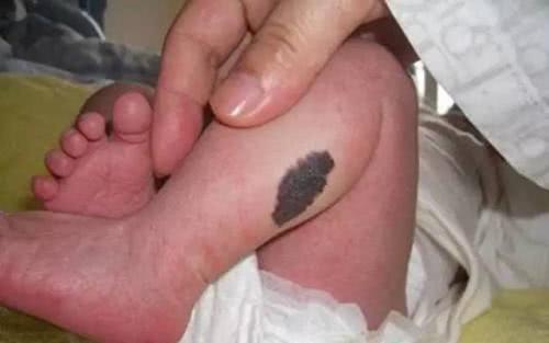 宝宝身上的这些胎记可能预示着某些疾病,家长们要注意了