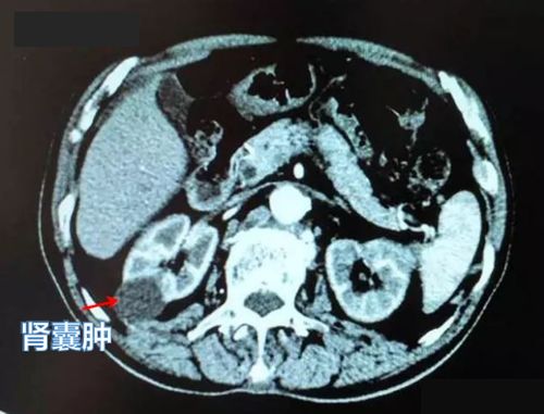 体检报告查出有肾囊肿好担心，有什么办法吗