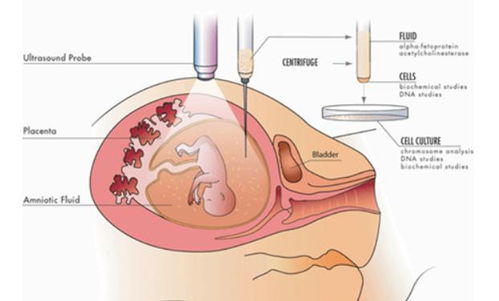30岁后准备生二胎的宝妈们, 羊水穿刺 要做这些准备