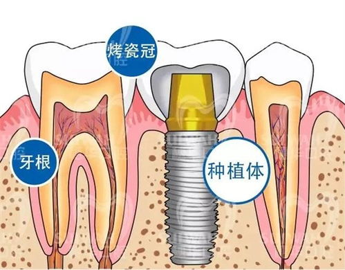 种植牙到底能用多久 答案都在这里