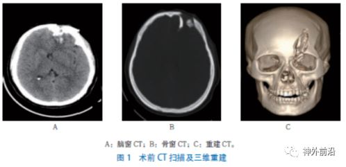 累及眉弓的眶额粉碎凹陷性骨折一期修复经验总结