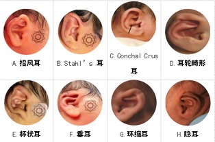 耳廓形态畸形 出生后两个月内是矫正最佳时机