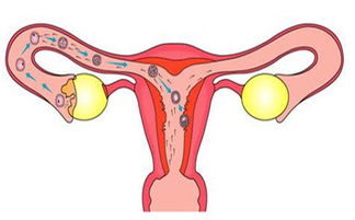 输卵管肿瘤(妇产科护理指导)