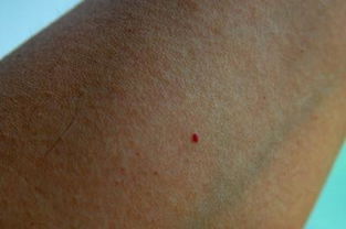 皮肤上长了很多小红点,像小红痣,不痛不痒的是怎么回事儿