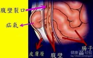 疝气手术后咳嗽会引起哪些并发症？