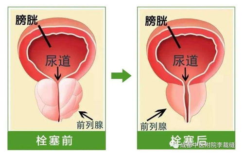 不开刀缓解前列腺增生问题,我们选择这样做......