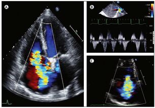 Lancet 三尖瓣疾病诊断与治疗进展要点总结