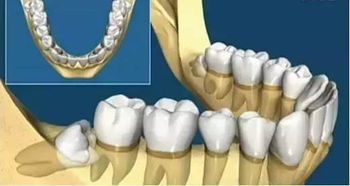 我们为什么要拔智齿 