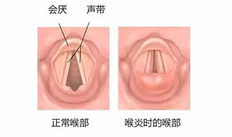 孩子长期声音嘶哑别不当回事儿,当心喉癌找上门 