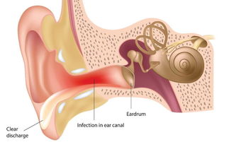 中耳道发炎怎么办(中耳道发炎严重吗)